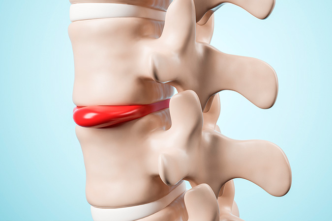 Лечение грыжи позвоночника. Межпозвонковая грыжа – не повод для операции