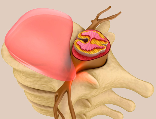 Межпозвонковая грыжа - повод для беспокойства. Лечение позвоночника.